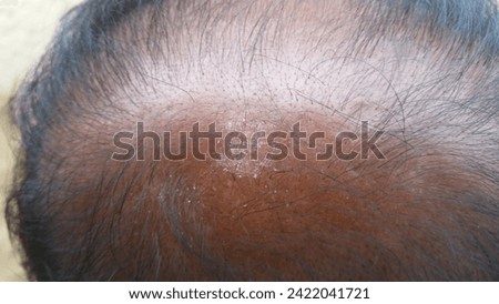 this is a picture of hair loss