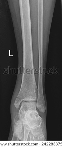 x-ray leg accident patient fractures were found in black background