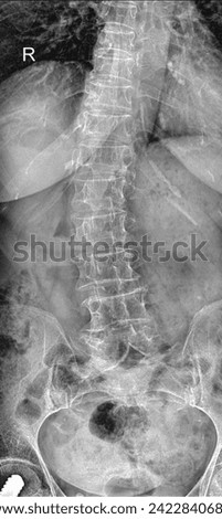 Medical x-ray of the spine body isolated on the white background