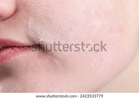 Woman with dry skin on face, closeup Royalty-Free Stock Photo #2423533779