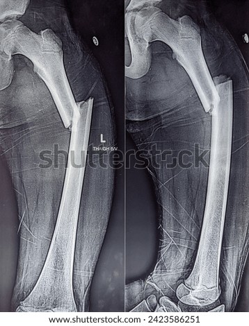 X Ray image of thigh showing femur fracture , radiological imaging of a bone fracture  Royalty-Free Stock Photo #2423586251