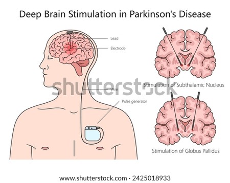 Deep brain stimulation structure Parkinson disease diagram hand drawn schematic vector illustration. Medical science educational illustration Royalty-Free Stock Photo #2425018933