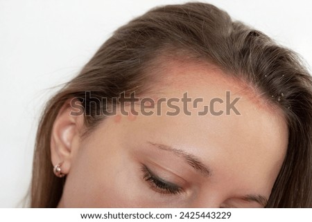 Inflammation of the scalp in a young woman. Problems with dandruff, seborrhea, itching, redness, dryness, lichen, fungal infection. Skin disease, dermatitis. Red round spots on the head and forehead Royalty-Free Stock Photo #2425443229