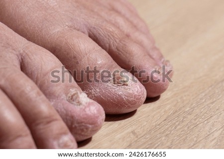 Cancer chemotherapy cause swelling of ankles (ankle oedema) , 
 skin to become dry, dark or peel and nails brittle or flaky. Royalty-Free Stock Photo #2426176655