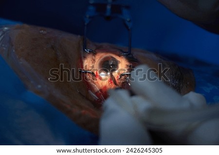 Phacoemulsification, destruction of the opaque lens by ultrasound, ophthalmic eye surgery. eye lens replacement, intraocular lens installation, surgical cataract treatment.  Royalty-Free Stock Photo #2426245305
