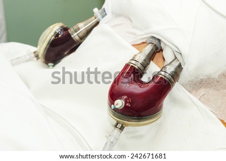 artificial heart in humans