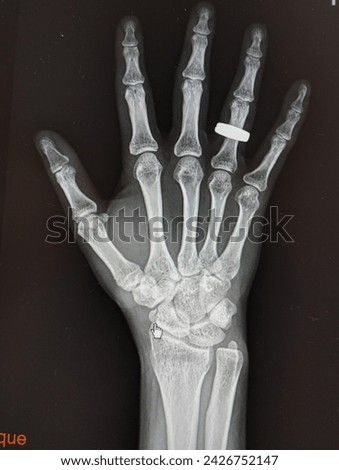 x-ray hand showing normal joint and bone
