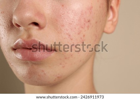 Teenage girl with acne problem on beige background, closeup Royalty-Free Stock Photo #2426911973
