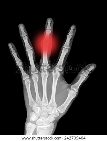 x-ray left hand
