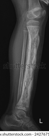 film x-ray leg lateral : show child's lower limb Royalty-Free Stock Photo #2427671143