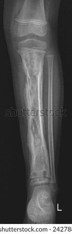 film x-ray leg ap : show child's lower limb injuries Royalty-Free Stock Photo #2427885925