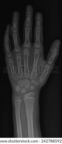 film x-ray forearm and hand : show infant's bone