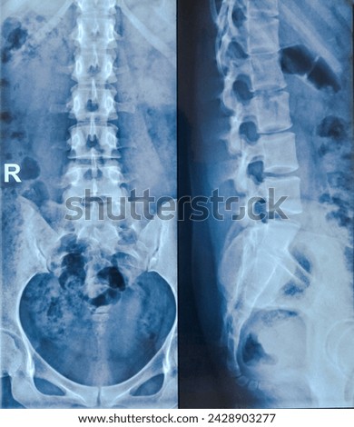 X-ray of the human Spine. Suggestive of muscle spasm. Mild scoliosis having leftward convexity is noted. 