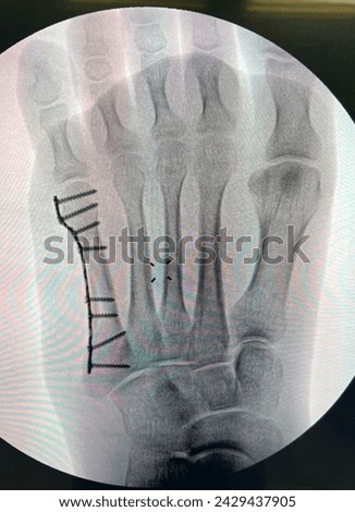 foot ankle injury patients from traffic accident fall from height sport injury cause bone fracture and ligament injury see in x-ray treat by surgery to make them better and reduce disability