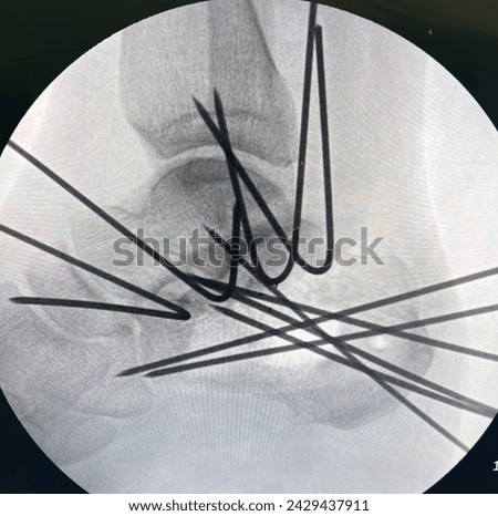 foot ankle injury patients from traffic accident fall from height sport injury cause bone fracture and ligament injury see in x-ray treat by surgery to make them better and reduce disability