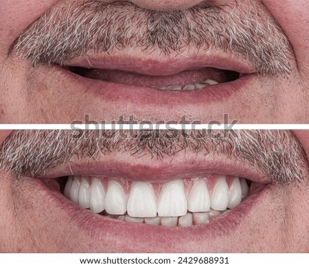 Porcelain dental prosthesis placed on implants. All-on-Four treatment. Royalty-Free Stock Photo #2429688931