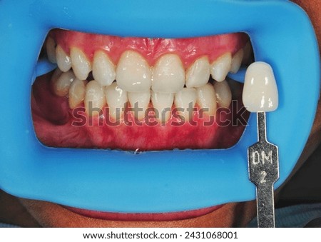 procedure for comparing the color shades of teeth before bleaching treatment at dental clinic. Royalty-Free Stock Photo #2431068001