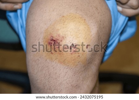 Superficial skin erosions in the knee resulting from a fall are cured with a disinfectant iodine solution Royalty-Free Stock Photo #2432075195