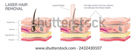 Laser hair removal is a procedure that uses a laser, or a concentrated beam of light on the skin to get rid of hair in the body vector illustration. Skin layers and how laser affects the body hair. Royalty-Free Stock Photo #2432430107