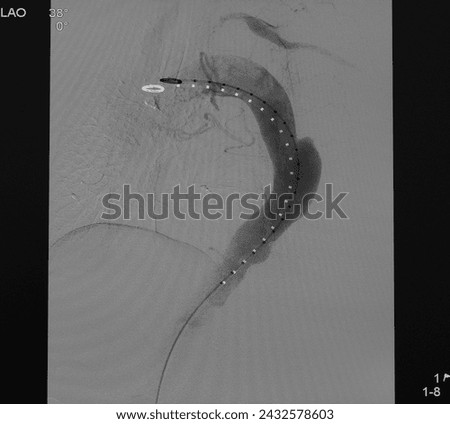 Aortogram was performed concealed rupture penetrating atherosclerotic ulcer (PAU) at descending aorta. Royalty-Free Stock Photo #2432578603