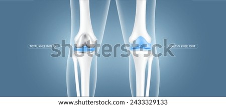 Total knee replacement surgery or implant and healthy leg bone cartilage. Treatment relieve arthritis, after joint damaged. Medical health care science technology concept. Vector EPS10. Royalty-Free Stock Photo #2433329133