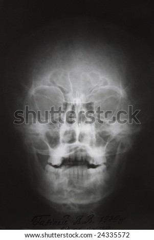 photo of frontal x-ray picture of human skull in natural colors