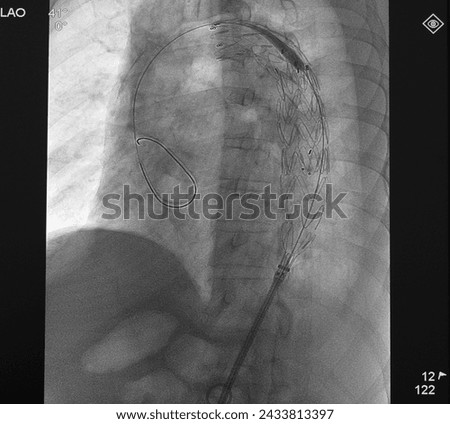 X ray image showed aortic stent graft deployment overlapping the other stent at thoracic aorta in thoracic endovascular aortic repair (TEVAR) procedure. Royalty-Free Stock Photo #2433813397