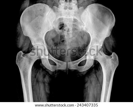 X-ray of the pelvis and spinal column of a woman Royalty-Free Stock Photo #243407335