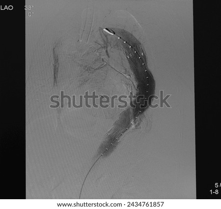 Aortogram was performed successful thoracic endovascular aortic repair (TEVAR) at descending aorta with aortic stent graft. Royalty-Free Stock Photo #2434761857