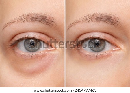 Close-up of the face of a young woman with a bag under her eye before and after treatment. Swelling of the lower eyelid. Removing bruises and dark circles using cosmetics and creams. Blepharoplasty Royalty-Free Stock Photo #2434797463