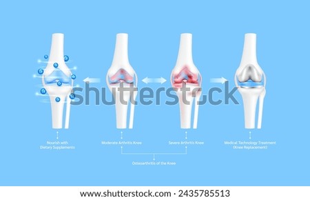 Osteoporosis or severe moderate arthritis joint. Leg bone cartilage ligament. Nourish with dietary supplements and Innovation medical technology treatment. Knee replacement surgery or implant. Vector. Royalty-Free Stock Photo #2435785513