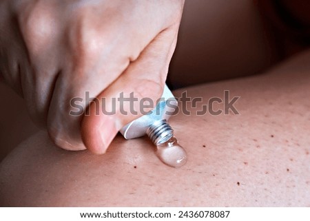 A man squeezes an anti-inflammatory gel treatment cream from a tube onto his leg. Treatment of arthrosis and arthritis, anti-inflammatory ointment for the treatment of joints, close-up, medicine Royalty-Free Stock Photo #2436078087