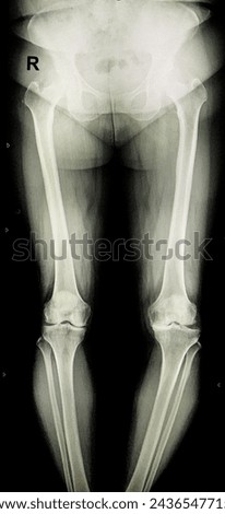 Bl lower limb scanogram ap  patient suffering from pain in left knee Royalty-Free Stock Photo #2436547715