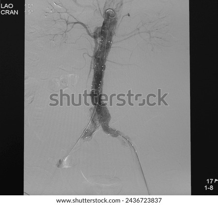 Aortogram was performed successful endovascular aneurysm repair (EVAR) at abdominal aorta with aortic stent graft. Royalty-Free Stock Photo #2436723837