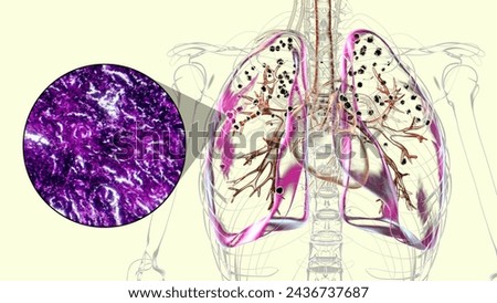 3D illustration and light micrograph depicting lungs affected by silicosis within a human body, revealing dark silicotic nodules, emphasizing respiratory health issues due to silica exposure.
