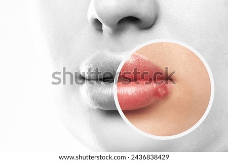 Woman showing herpes disease on her lips. Treatment of viral infections. Royalty-Free Stock Photo #2436838429