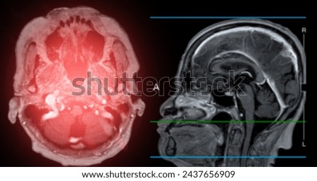 MRI  brain scan  sagittal plane for detect  Brain  diseases sush as stroke disease, Brain tumors and Infections.
