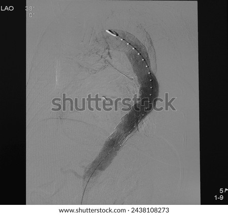 Aortogram was performed successful thoracic endovascular aneurysm repair (TEVAR) at descending aorta with aortic stent graft. Royalty-Free Stock Photo #2438108273