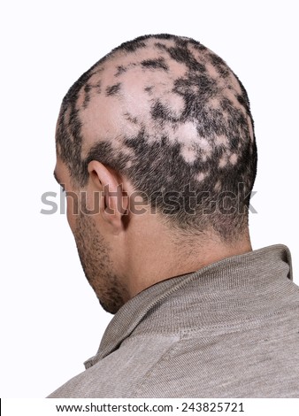 Alopecia Royalty-Free Stock Photo #243825721