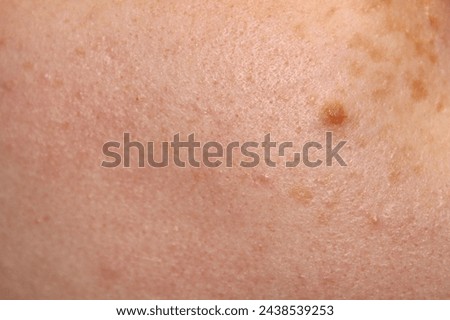 Skin texture of a girl with freckles and a birthmark close-up. Close-up stock photo of human skin in best quality.