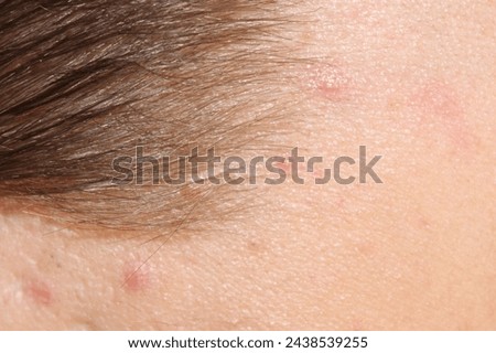 Problem skin with acne on the body. Stock human skin texture in the best quality. Photo with scars.