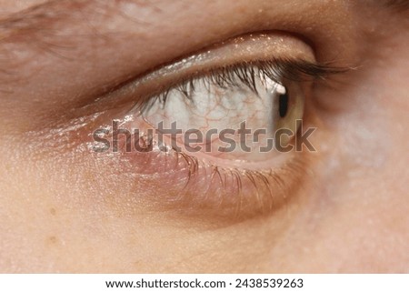 Tired green eye with red capillaries. The concept of long-term work at the computer and vision treatment. White of the eye with red veins. Stock photos of ophthalmology in the best quality.