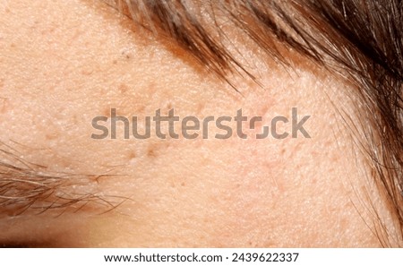 Skin with acne scars. Stock human skin texture in the best quality. Photo with scars.