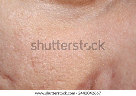 Enlarged pores on the face and acne scars. Dermatology stock photos in the best quality.