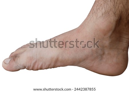 Photo of a Red imported fire ant biting the foot causing an allergic reaction with a rash on the side of the foot.