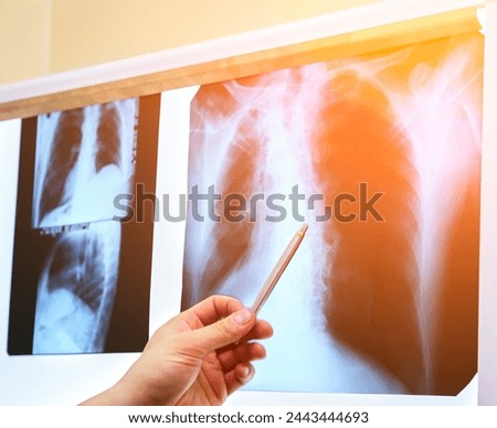 Black and white medical chest x-ray. A picture of the lungs in the doctor's office on the wall.
