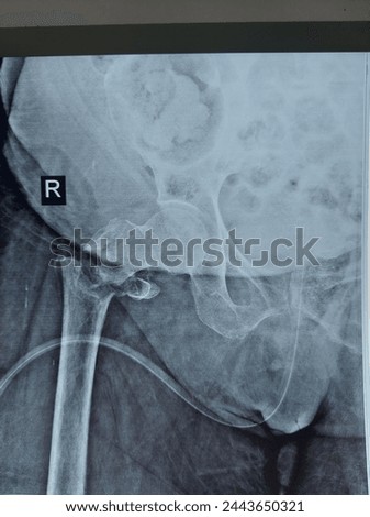 subtrochanteric fracture of femur bone  Royalty-Free Stock Photo #2443650321