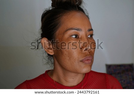 Freckles and Spot melasma pigmentation skin facial treatment over Asian woman face.Wrinkles, melasma, Dark spots, freckles, dry skin.Problem skincare and health concept. Before and after Royalty-Free Stock Photo #2443792161