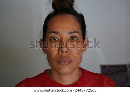 Freckles and Spot melasma pigmentation skin facial treatment over Asian woman face.Wrinkles, melasma, Dark spots, freckles, dry skin.Problem skincare and health concept. Before and after Royalty-Free Stock Photo #2443792163
