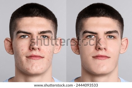 Acne problem. Young man before and after treatment on grey background, collage of photos Royalty-Free Stock Photo #2444093533